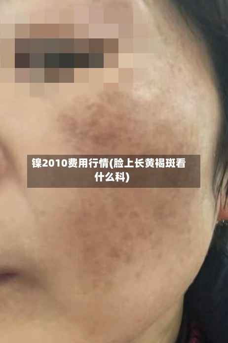 镍2010费用行情(脸上长黄褐斑看什么科)-第3张图片